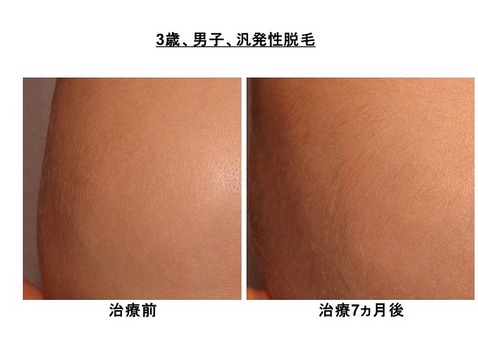 円形脱毛症　病院""